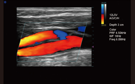 carotid bifurcation