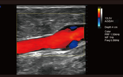 reflux vein